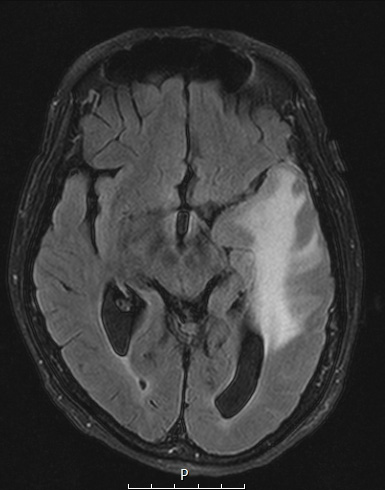 1A1 Meningioma, secretory (Case 1) FLAIR - Copy