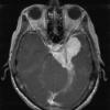 1A2 Meningioma, secretory (Case 1) T1W 1 - Copy