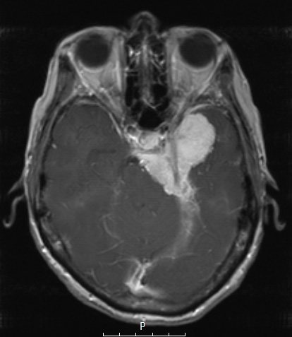 1A2 Meningioma, secretory (Case 1) T1W 1 - Copy