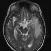 1A3 Meningioma, secretory (Case 1) T2 no C 3 - Copy