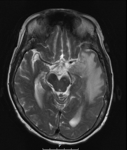 1A3 Meningioma, secretory (Case 1) T2 no C 3 - Copy