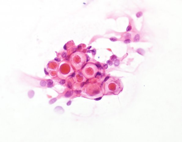 1B1 Meningioma, secretory (Case 1) smear