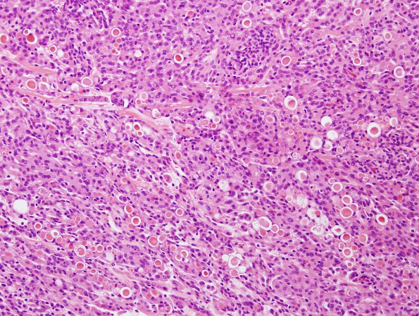 1B2 Meningioma, secretory (Case 1) H&E 5