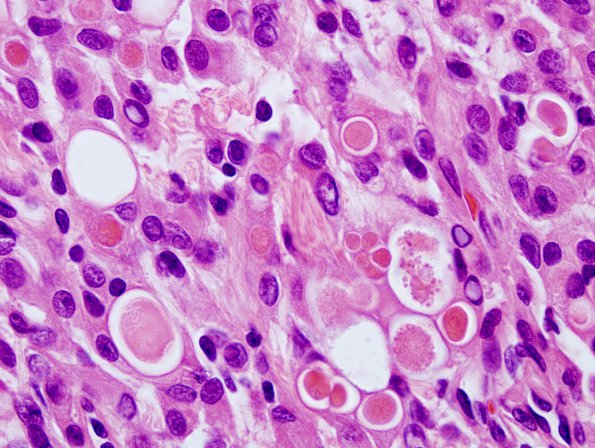 1B3 Meningioma, secretory (Case 1) H&E 2