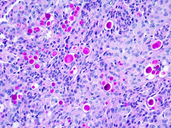 1C Meningioma, secretory (Case 1) PAS 1.jpg