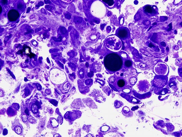 1D Meningioma, secretory (Case 1) Plastic 2