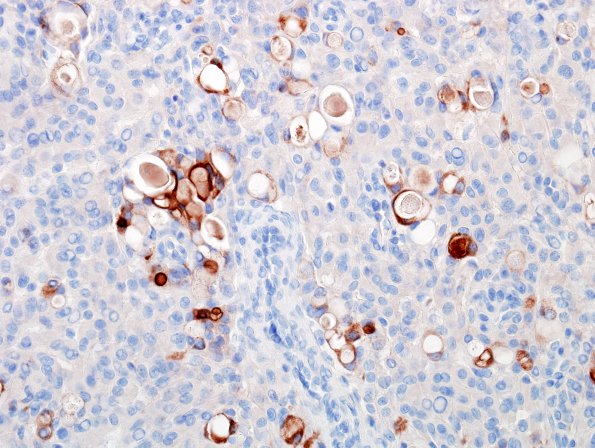 1E Meningioma, secretory (Case 1) EMA