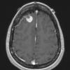 2A Meningioma, secretory (Case 2) T1W - Copy