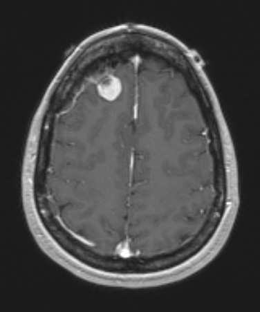 2A Meningioma, secretory (Case 2) T1W - Copy