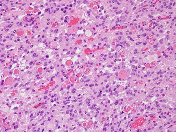 2B1 Meningioma, secretory (Case 2) H&E 5.jpg