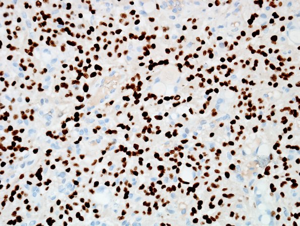 2C2 Meningioma, secretory (Case 2) PR 1.jpg