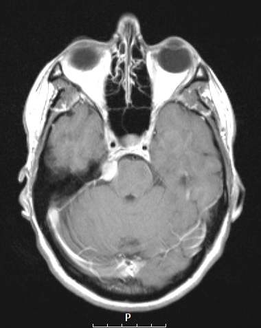 3A Meningioma, secretory (Case 3) T1W 2 - Copy