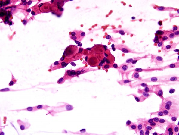 3B1 Meningioma, secretory (Case 3) H&E smear 5.jpg