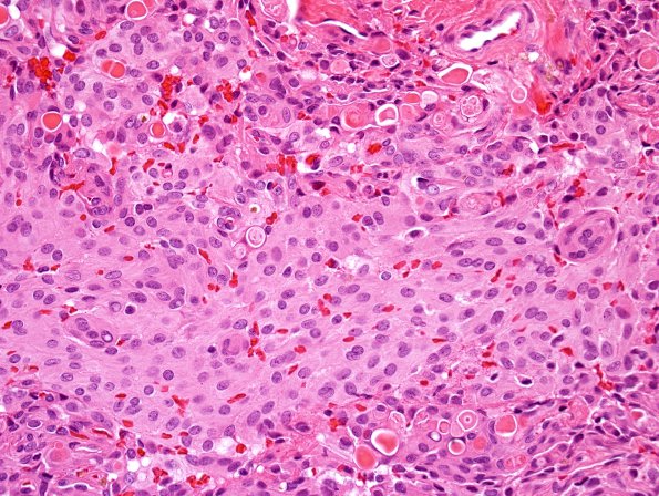 3B2 Meningioma, secretory (Case 3) H&E 1.jpg