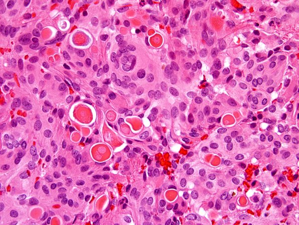 3B3 Meningioma, secretory (Case 3) H&E 2.jpg