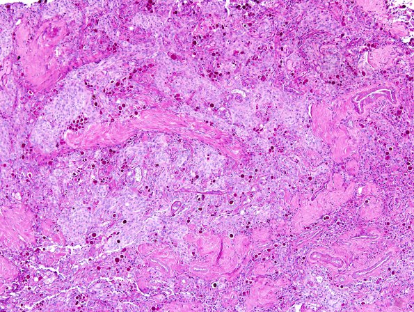 3C1 Meningioma, secretory (Case 3) PAS 5.jpg