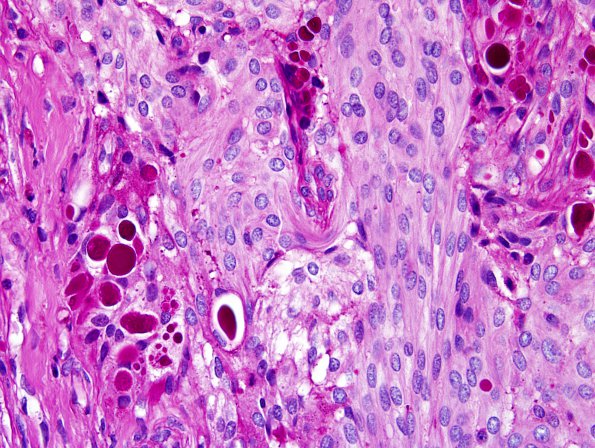 3C2 Meningioma, secretory (Case 3) PAS 1.jpg