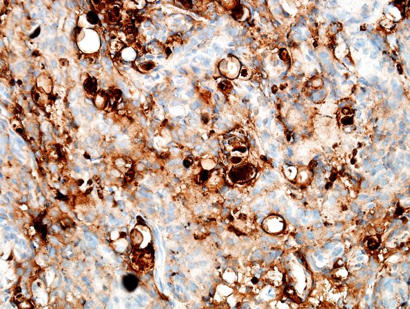 3E Meningioma, secretory (Case 3) CEA-mono 2.jpg