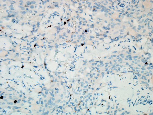 3F Meningioma, secretory (Case 3) Ki67.jpg