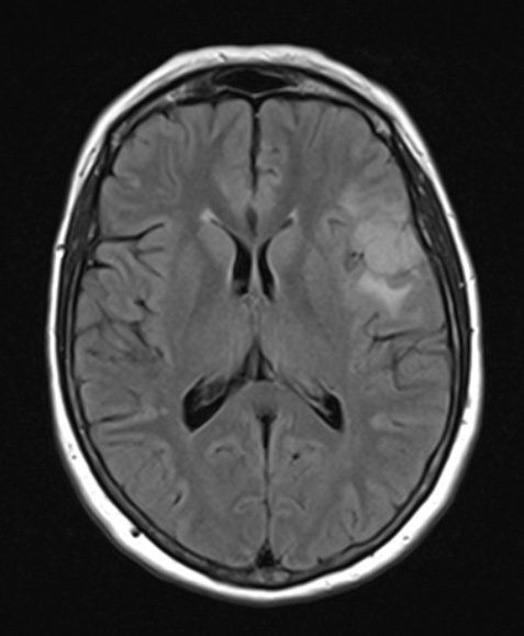 4A1 Meningioma, secretory (Case 4) FLAIR - Copy