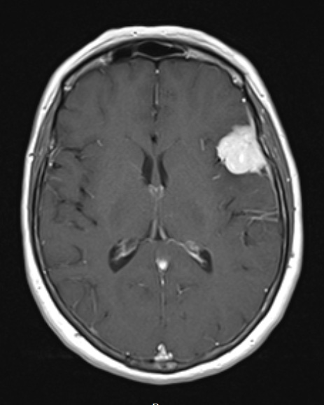 4A2 Meningioma, secretory (Case 4) T1W - Copy