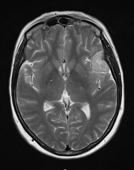 4A3 Meningioma, secretory (Case 4) T2noC - Copy