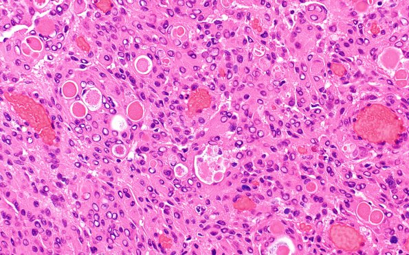 4B1 Meningioma, secretory (Case 4) H&E 4