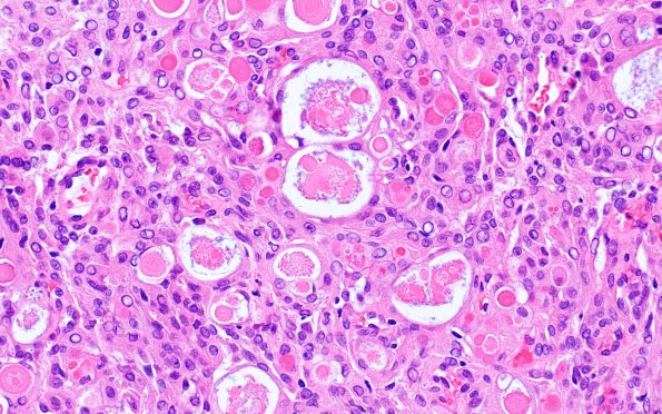 4B2 Meningioma, secretory (Case 4) H&E 2