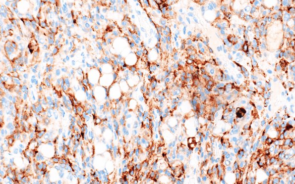 4C Meningioma, secretory (Case 4) EMA 2