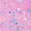 4E1 Meningioma, secretory (Case 4) Alcian blue 2