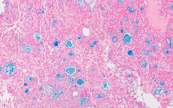 4E1 Meningioma, secretory (Case 4) Alcian blue 2