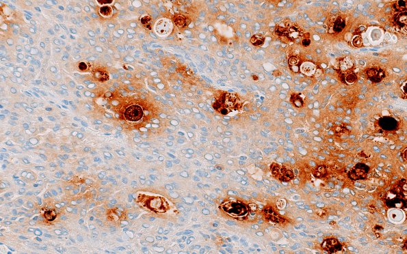 4G Meningioma, secretory (Case 4) CEA 1