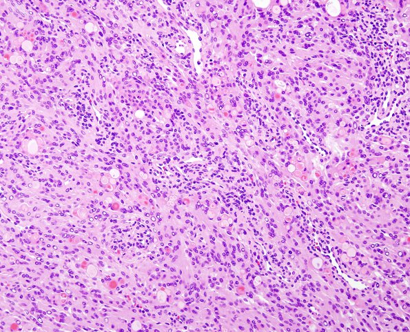 5A1 Meningioma, secretory (Case 5) H&E 2