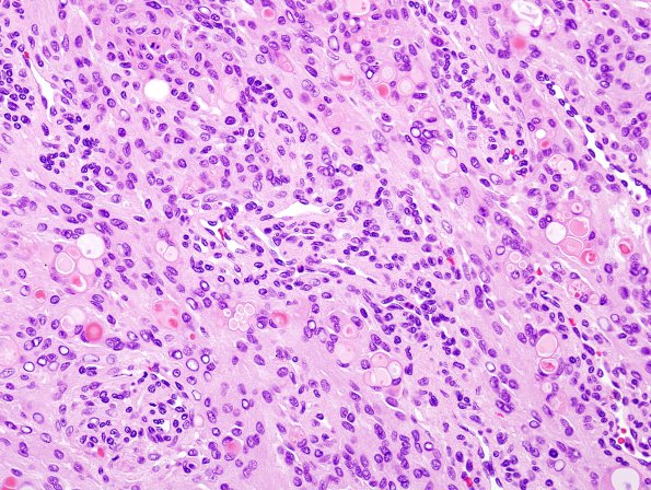 5A2 Meningioma, secretory (Case 5) H&E 1