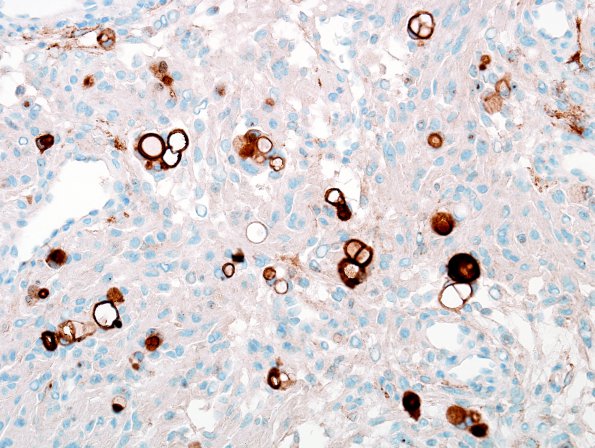 5B Meningioma, secretory (Case 5) EMA 1