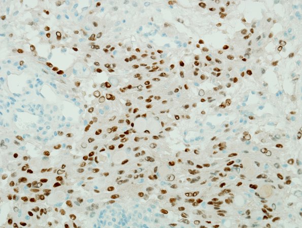 5C Meningioma, secretory (Case 5) PR 1