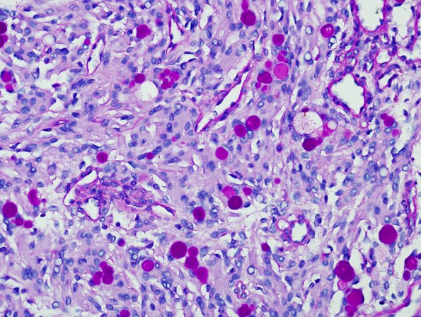 5D Meningioma, secretory (Case 5) PAS 2