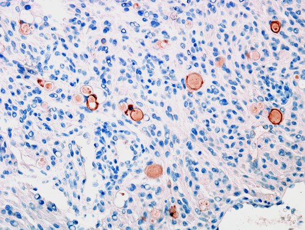 5E Meningioma, secretory (Case 5) CAM5.2