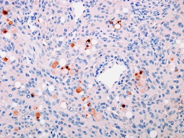 5F Meningioma, secretory (Case 5) CEA