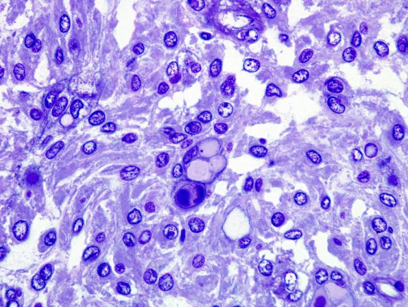 5G1 Meningioma, secretory (Case 5) Plastic 3