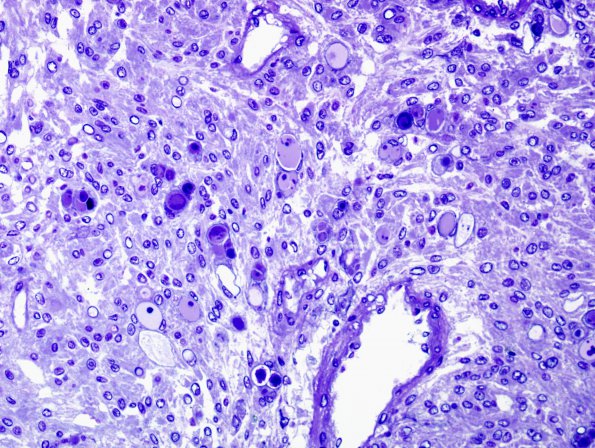 5G2 Meningioma, secretory (Case 5) Plastic 6