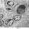 5H1 Meningioma, secretory (Case 5) EM 3 - Copy