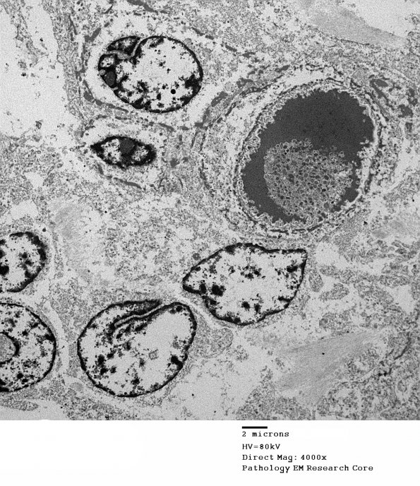 5H1 Meningioma, secretory (Case 5) EM 3 - Copy