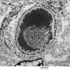 5H2 Meningioma, secretory (Case 5) EM 2 - Copy