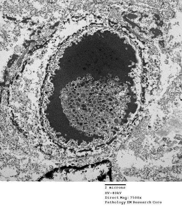 5H2 Meningioma, secretory (Case 5) EM 2 - Copy