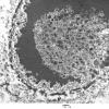 5H3 Meningioma, secretory (Case 5) EM 1 - Copy