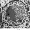 5H4 Meningioma, secretory (Case 5) EM 5 - Copy