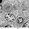 5H5 Meningioma, secretory (Case 5) EM 7 - Copy