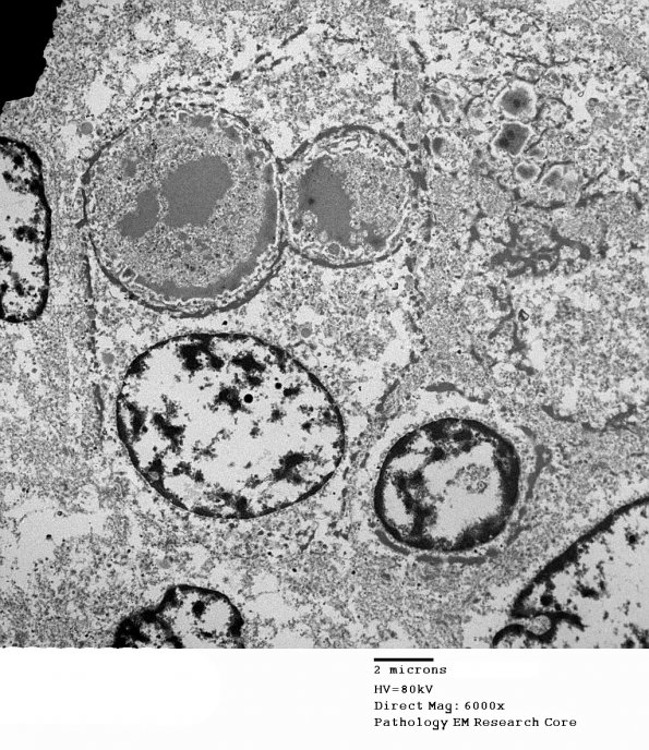 5H5 Meningioma, secretory (Case 5) EM 7 - Copy