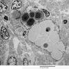 5H6 Meningioma, secretory (Case 5) EM 9 - Copy